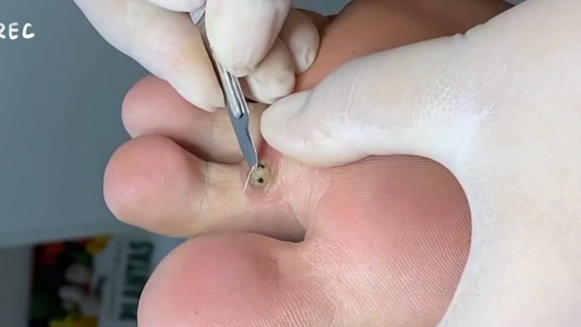 脚底长了一颗鸡眼,看师傅一刀切除