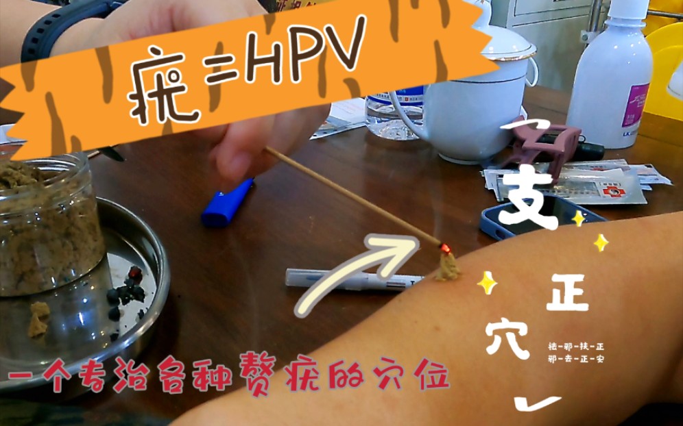 疣=HPV!!麦粒灸支正穴治疗扁平疣,其他各种赘疣同样可以.HPV—人乳头瘤病毒,令女性闻之色变.平疣、寻常疣、丝状疣、尖锐某疣等,都属于HPV...