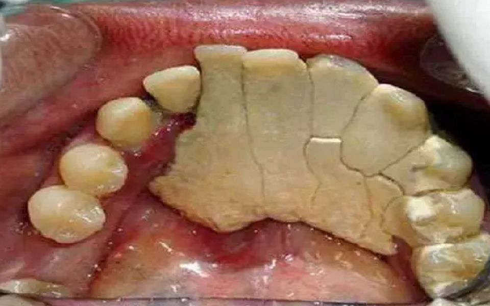 [图]千万别用手扣牙结石！过来人紧急支招，在家就能刷掉成片顽固牙石！