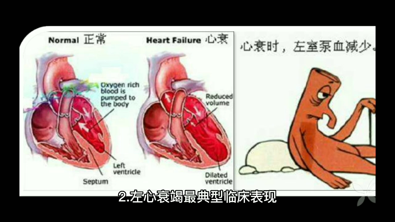 1.静脉炎的典型表现为沿静脉走向出现条索状红线.哔哩哔哩bilibili