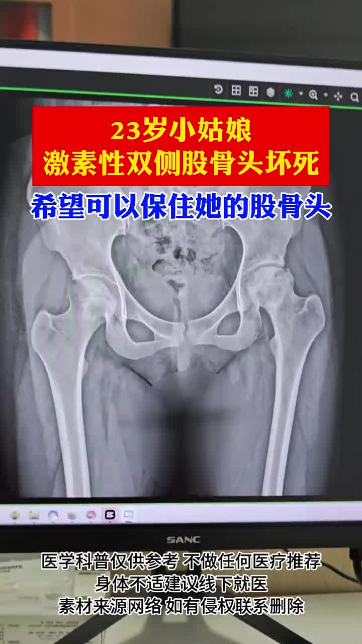 23岁小姑娘双侧激素性股骨头坏死