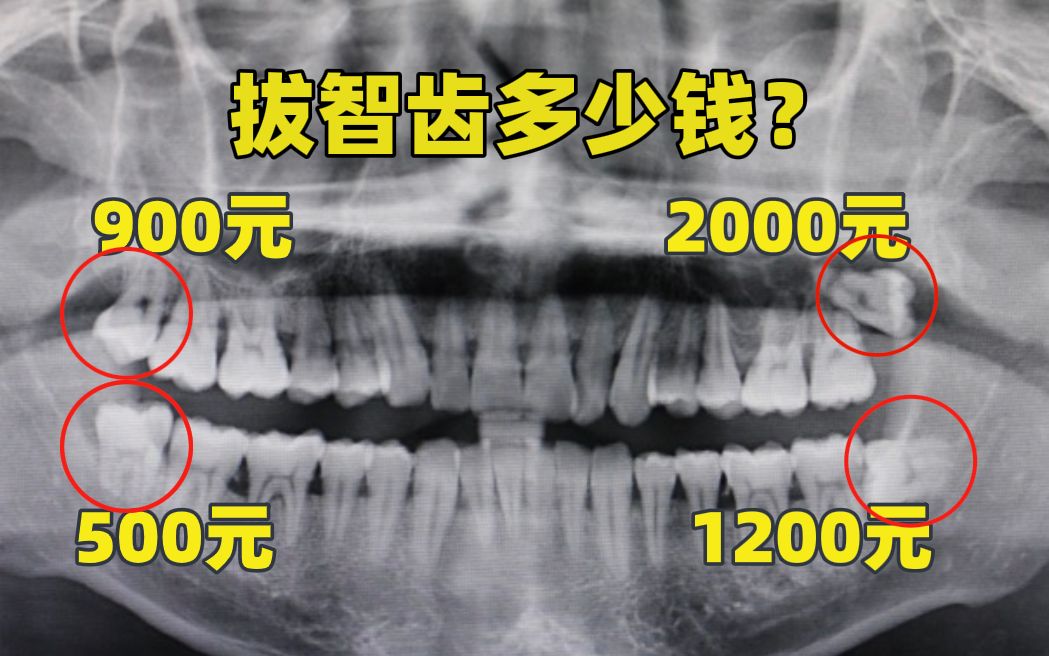 拔智齿要花多少钱?价格参考送上!哔哩哔哩bilibili