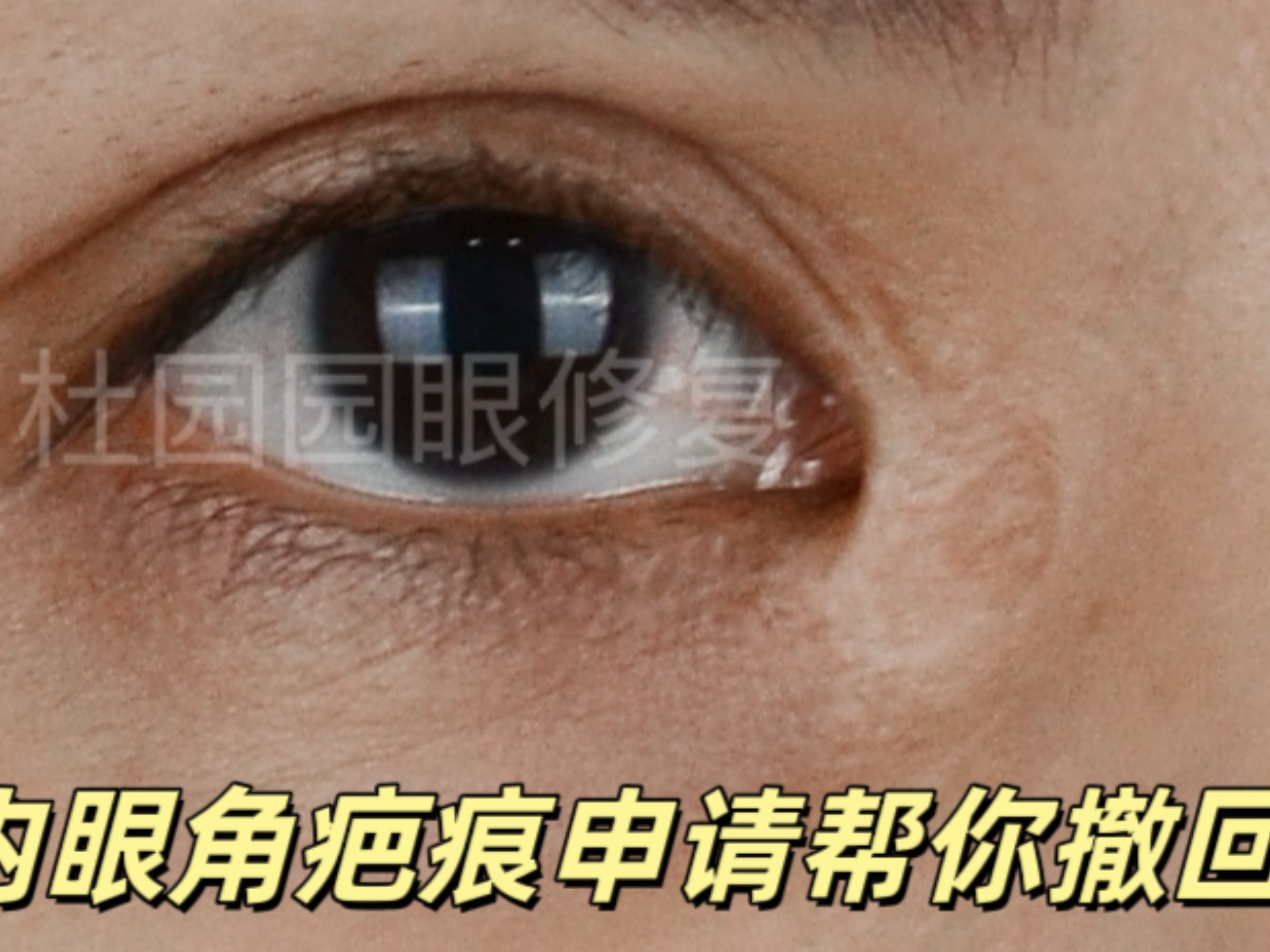 内眼角疤痕明显,申请帮你撤回