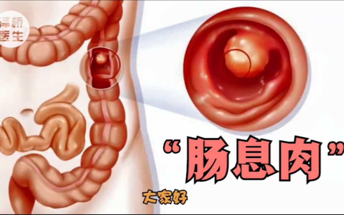 肠息肉的自白:我是谁?我从哪里来?我要到哪里去?哔哩哔哩bilibili