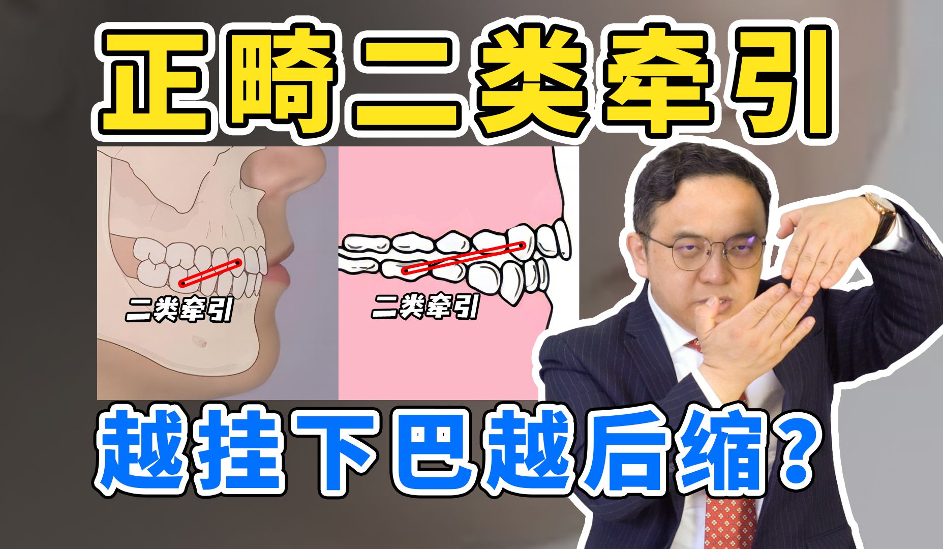 嘴凸整牙必看!正畸二类牵引越挂下巴越后缩?