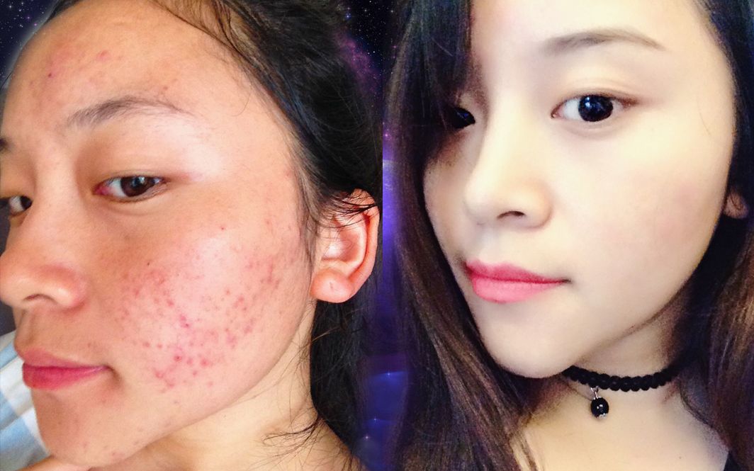 祛痘其实不是多少钱的问题而是祛痘的方法