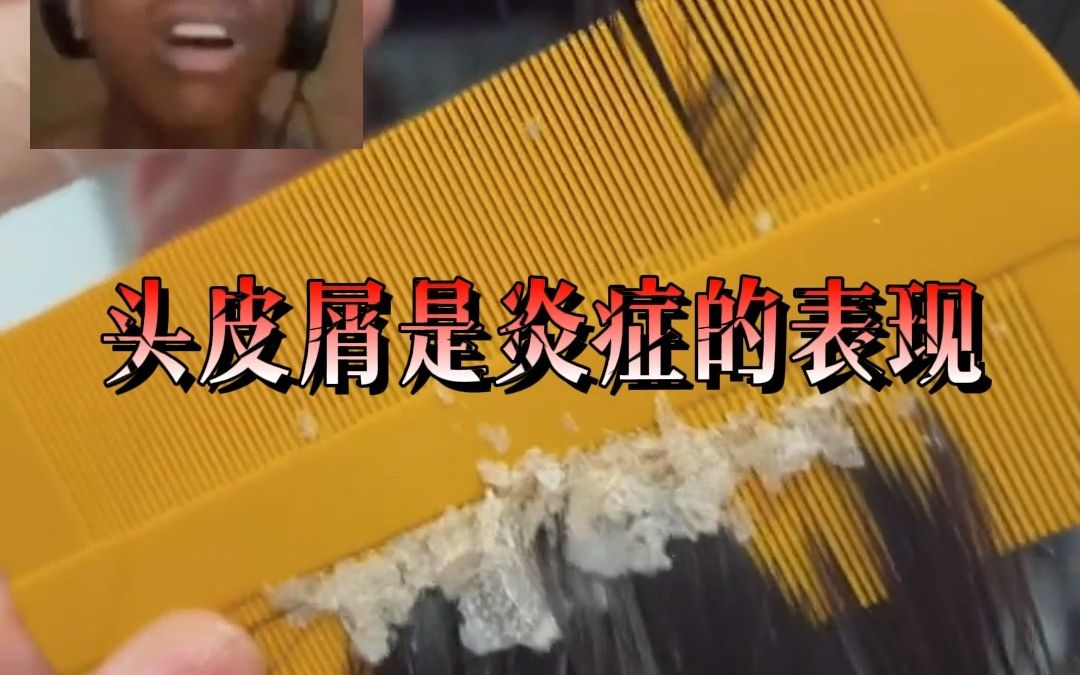 这个宝藏牌子瞒不住了!德国酮康唑洗剂真的能够回购到老,和头屑说再见!哔哩哔哩bilibili