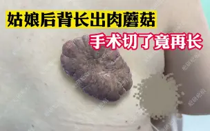 美女后背惊现“肉蘑菇”手术切都切不掉