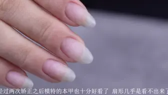 肉包甲矫正 这是第二次啦 第一次在之前教程主要是第一次比较长时间的处理让指缘皮有了很大改善下次来准备把甲片卸除到时给打击看看甲床的对比喜欢的宝宝记得点赞哦 哔哩哔哩 Bilibili