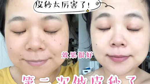 第二次做皮秒了！效果真的很好~