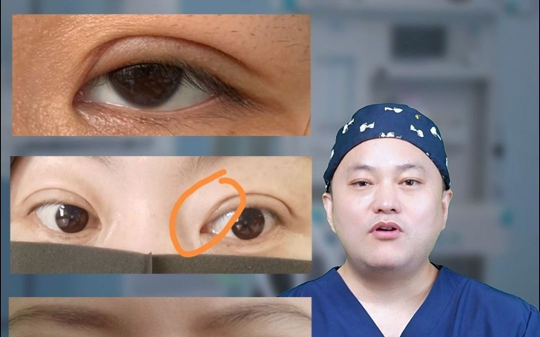 双眼皮线条不流畅,出现折角,怎么办?