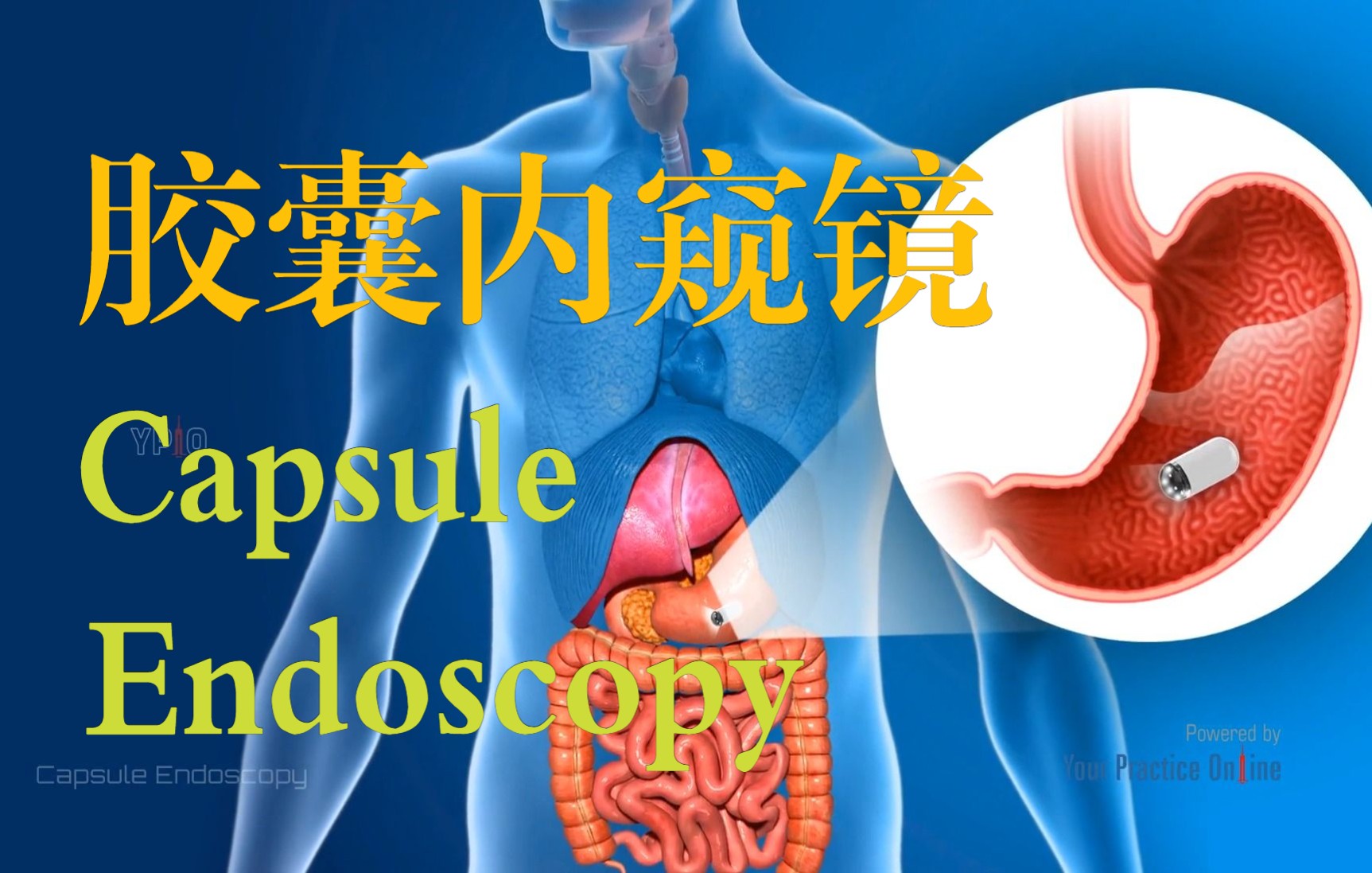 [图]胶囊内窥镜||Capsule Endoscopy