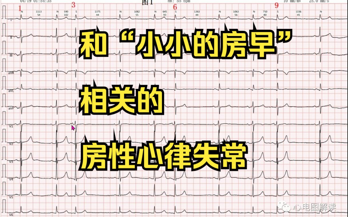 [图]和“小小的房早”相关的房性心律失常