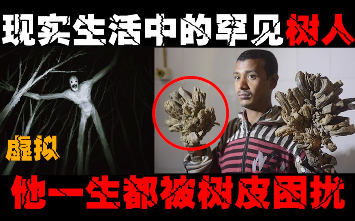 [图]【真实树人】密恐慎入！身上不断长出树皮，饱受怪异疾病的困扰，至今也未研究出治疗方法。