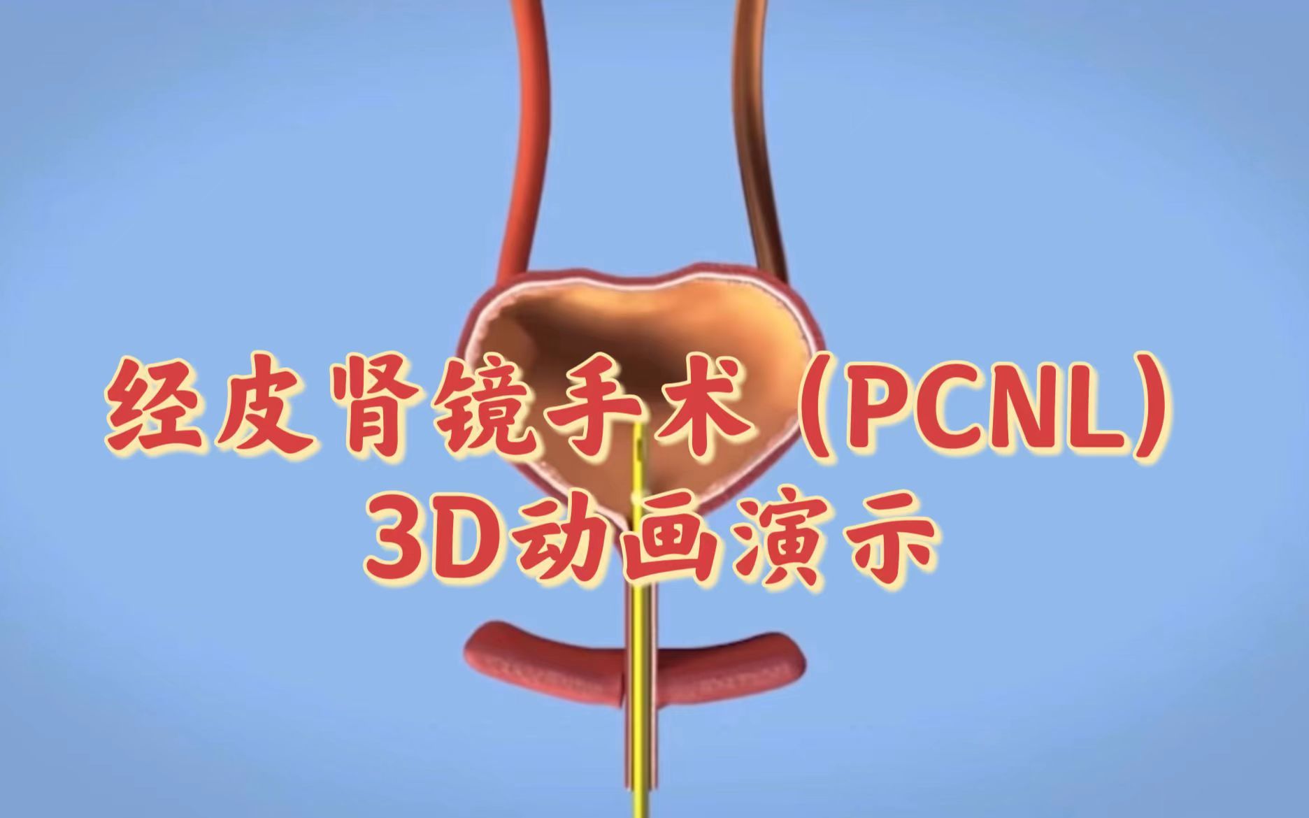 肾结石 | 一个视频让你看懂经皮肾镜手术(PCNL),让肾结石无处遁形的天敌哔哩哔哩bilibili