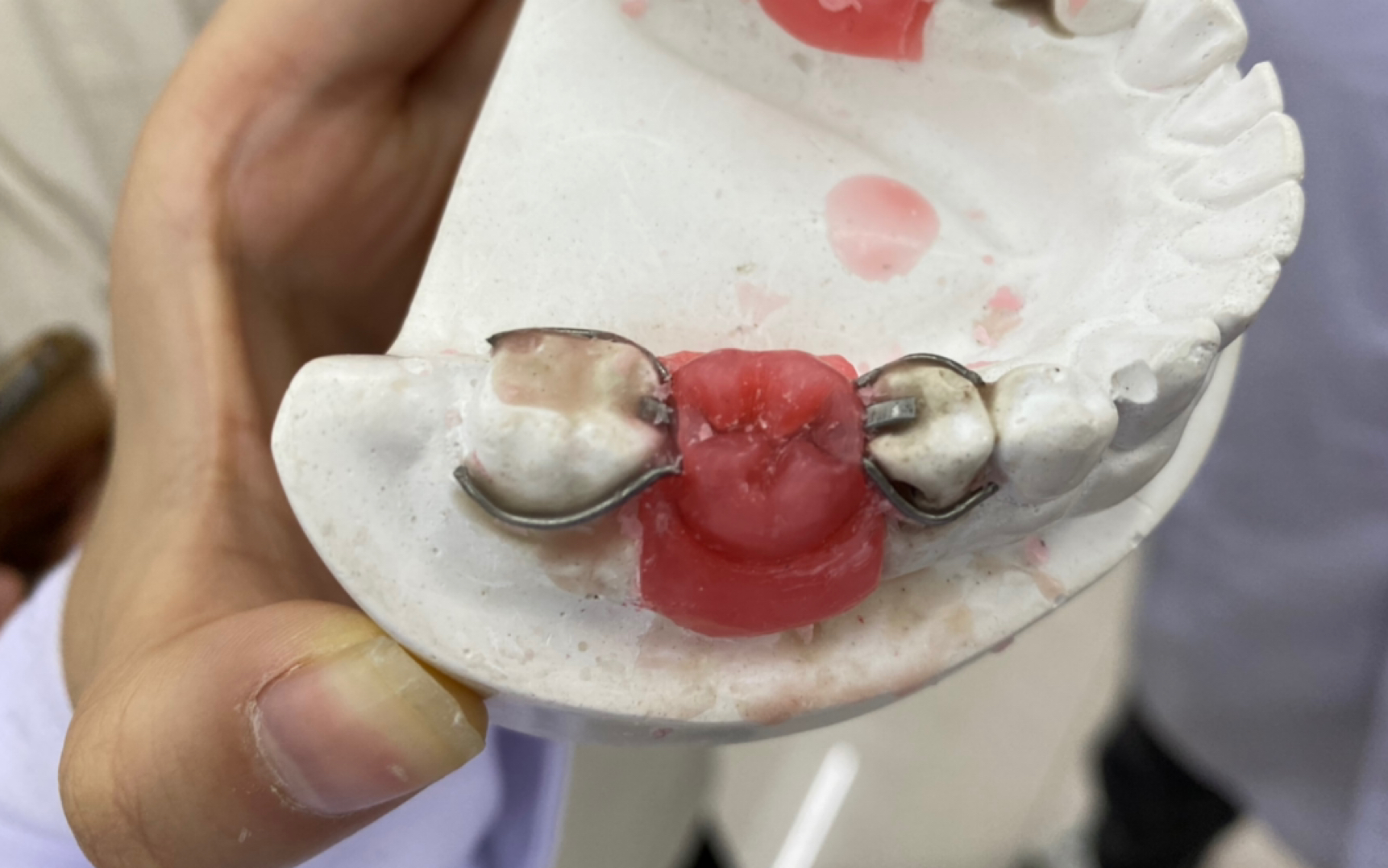 【自存】口腔修复实验课——可摘局部义齿(雕牙,蜡型制作)