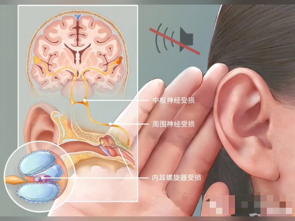 提醒大家,一旦出现突发性耳聋,一定要及时就诊