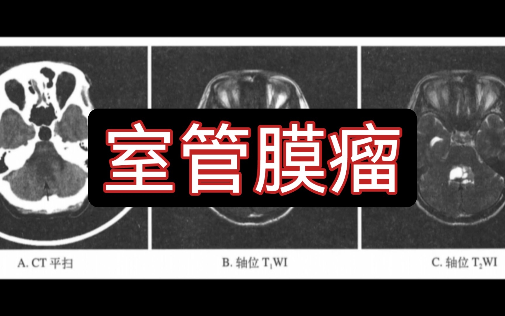 【医学影像】跟我一起刷病例 | 室管膜瘤哔哩哔哩bilibili