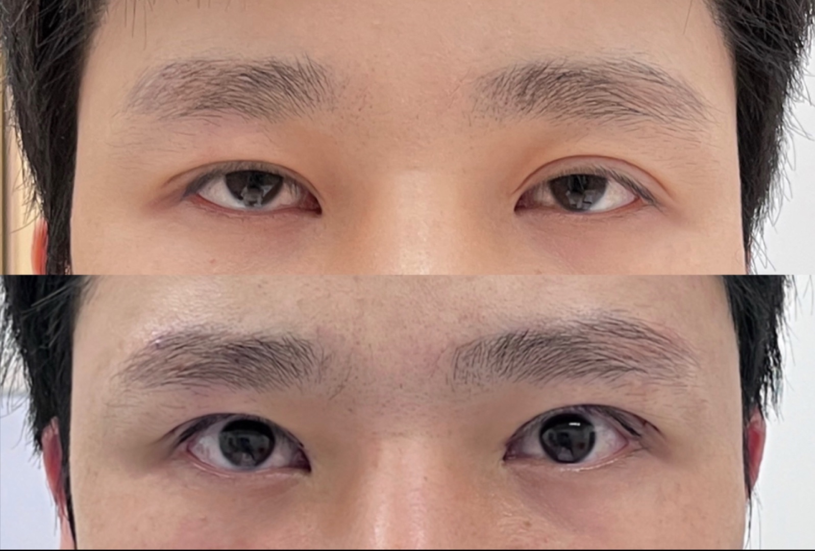 大小眼 不对称 男生眼睛宽改窄 尽显英气!自然妈生