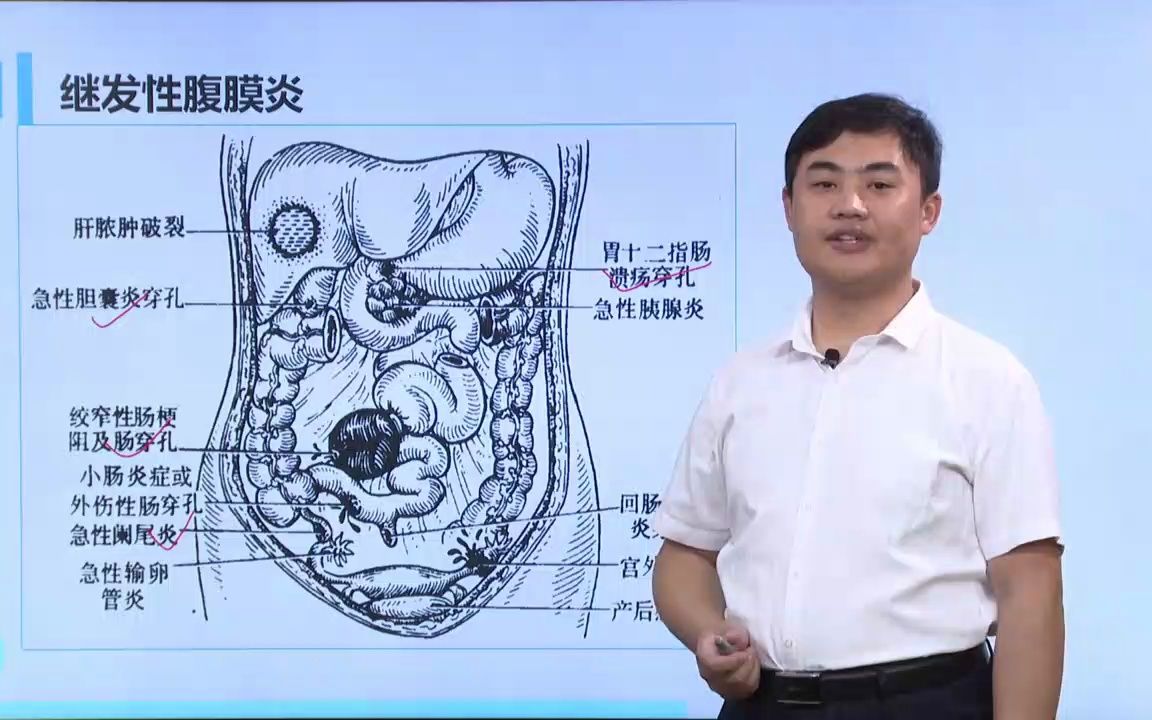 [10.2.1] 急性化脓性腹膜炎哔哩哔哩bilibili