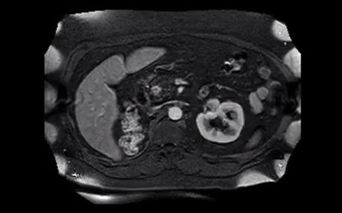 097(肾细胞癌胰腺转移)Metastatic renal cell carcinoma to the pancreas哔哩哔哩bilibili