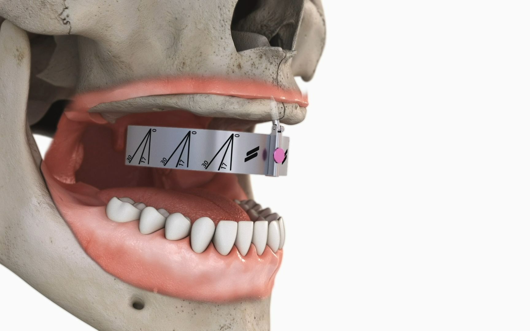无牙颌患者的福音!低可用骨患者使用blx种植体实现即刻修复