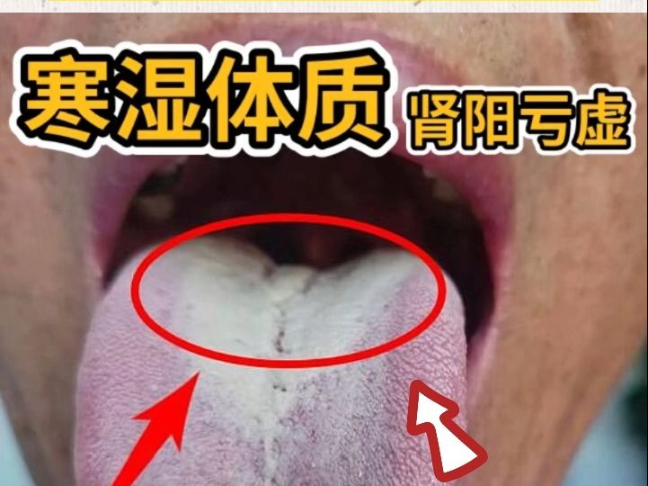 舌診分析:寒溼,溼熱,痰溼,3大體質舌象都是什麼樣的?