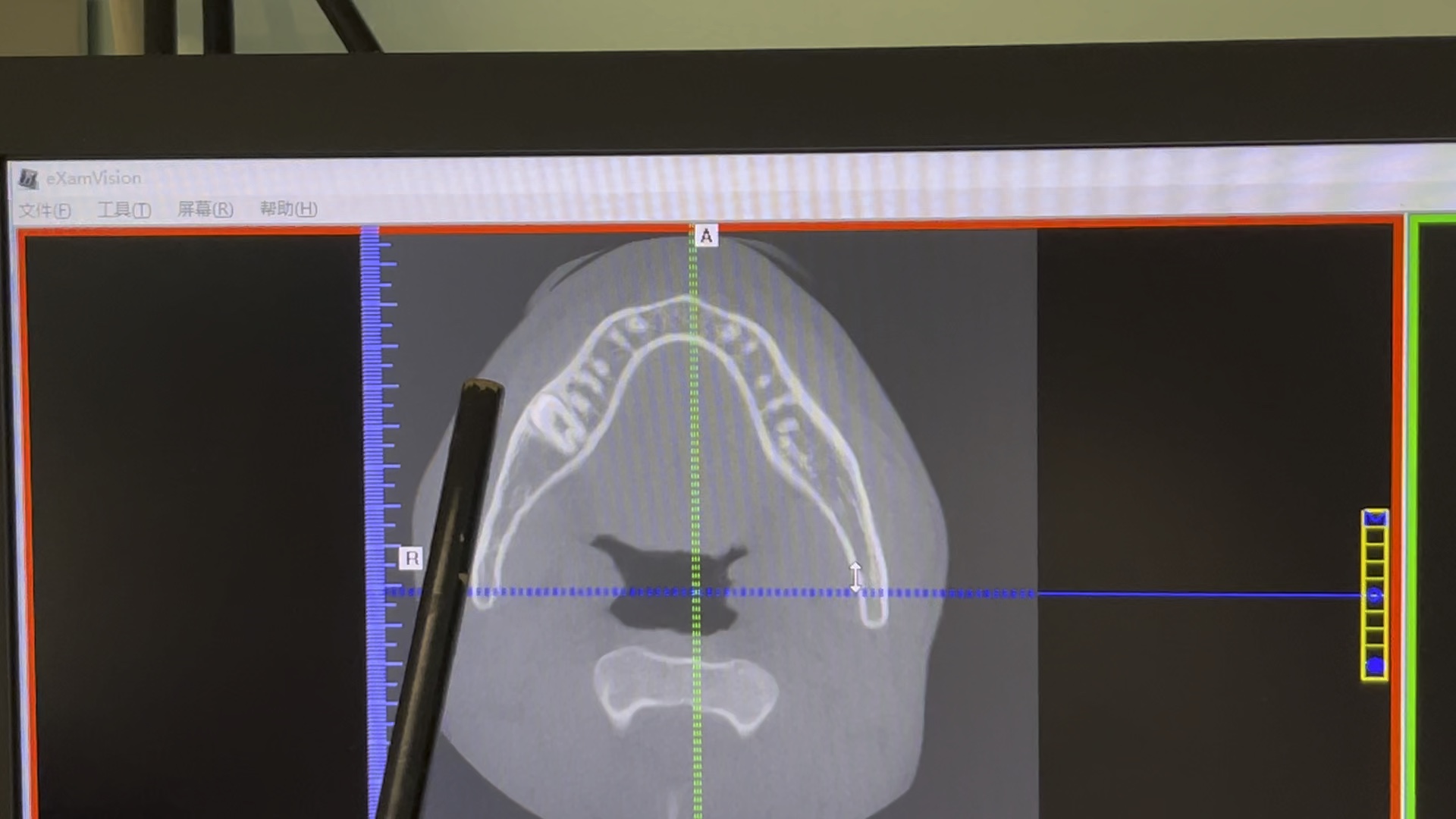 下颌第二磨牙的阻生