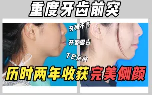 Download Video: 女生侧颜颜值逆袭！真人矫正24岁 骨性双颌前突/拔牙案例矫正分析