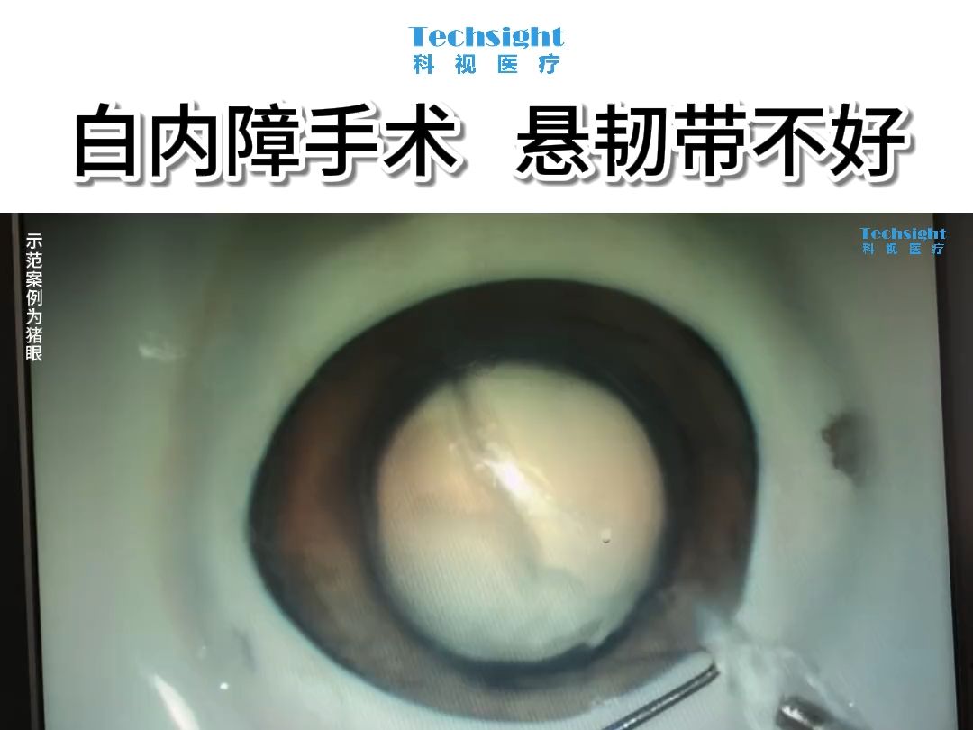 白内障手术——悬韧带不好的猪眼