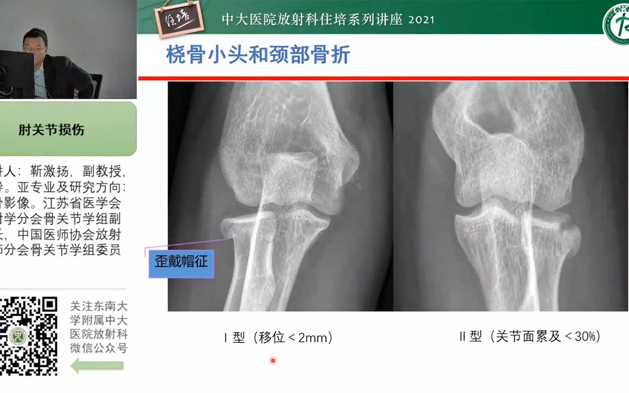 肘关节损伤中大靳激扬哔哩哔哩bilibili