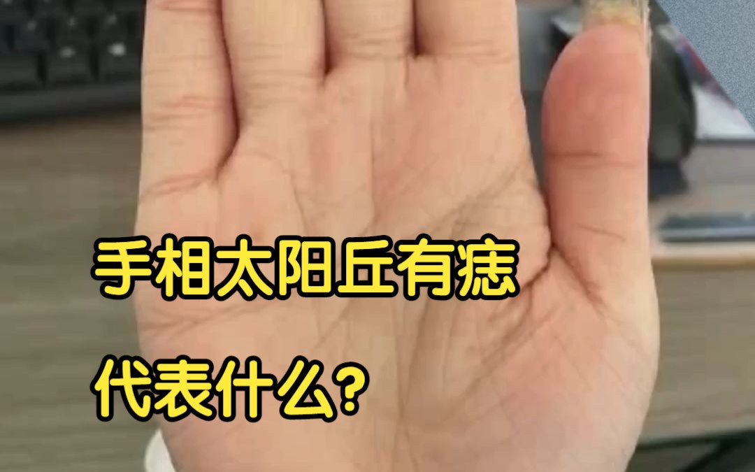 手相太阳丘有痣 代表什么?