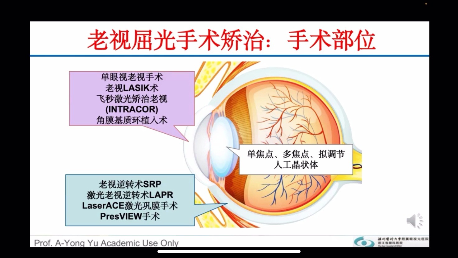 多焦点IOL治疗老视的临床思考哔哩哔哩bilibili