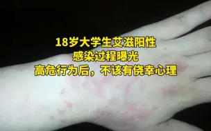 Download Video: 18岁大学生艾滋阳性，感染过程曝光：高危行为后，不该有侥幸心理