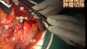 胰腺肿瘤切除术
