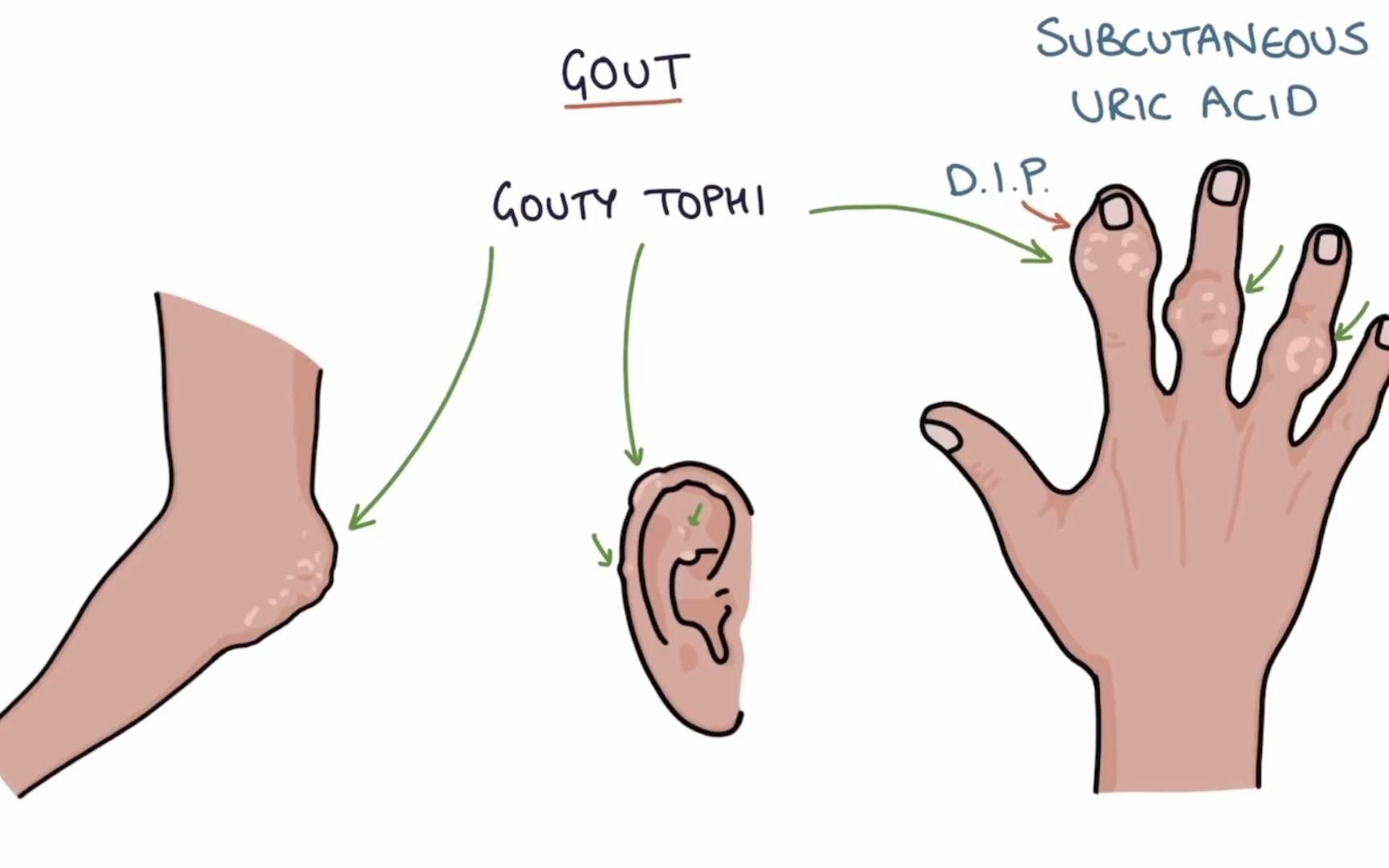 Gout痛风英文ppt讲解哔哩哔哩bilibili