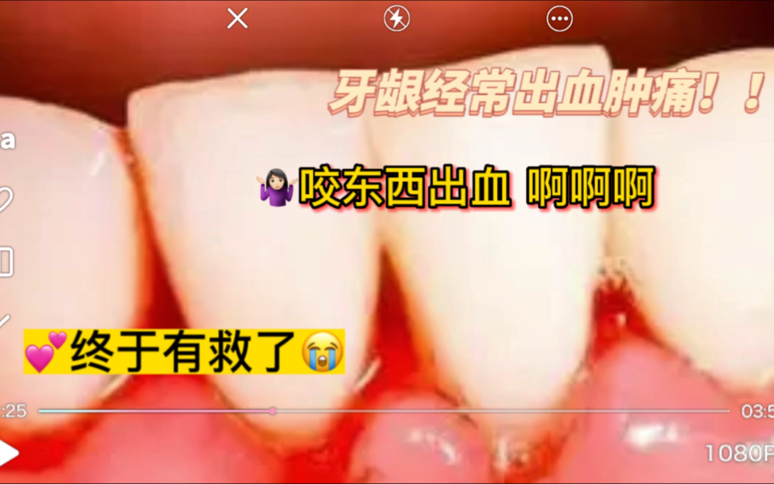 牙龈经常出血肿痛,有救了哔哩哔哩bilibili