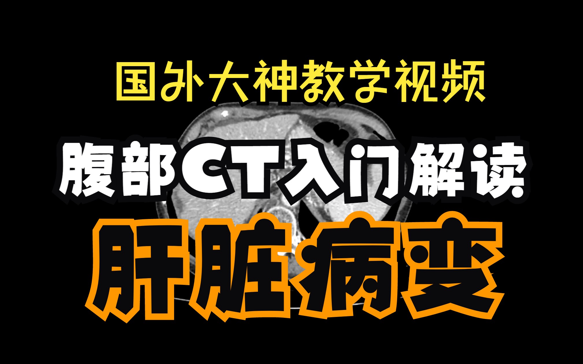 腹部CT入门解读—肝硬化、门静脉高压症、血吸虫病(国外大神教学视频)哔哩哔哩bilibili