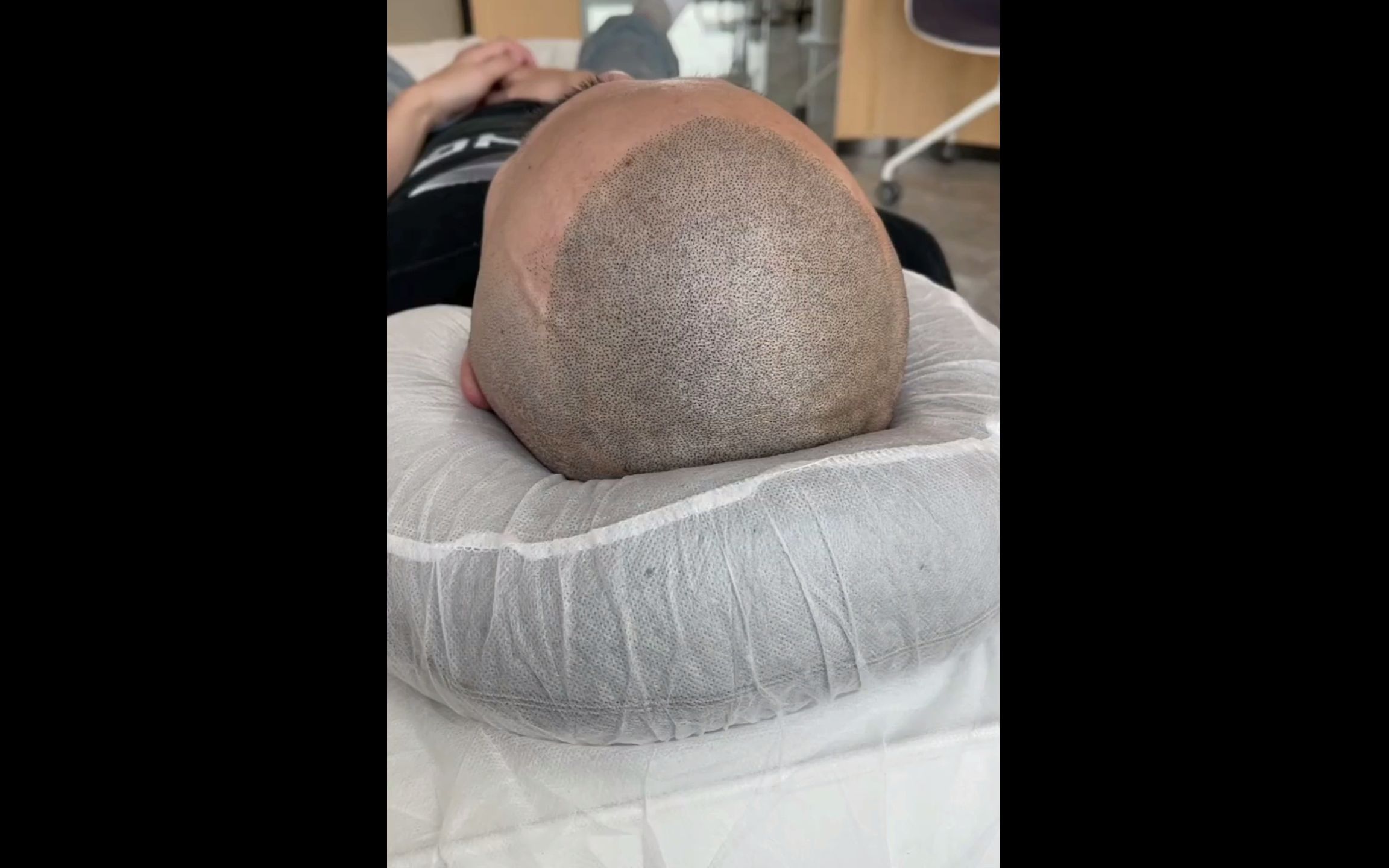 全秃,头顶光秃秃也能改变,看看前后对比的样子!