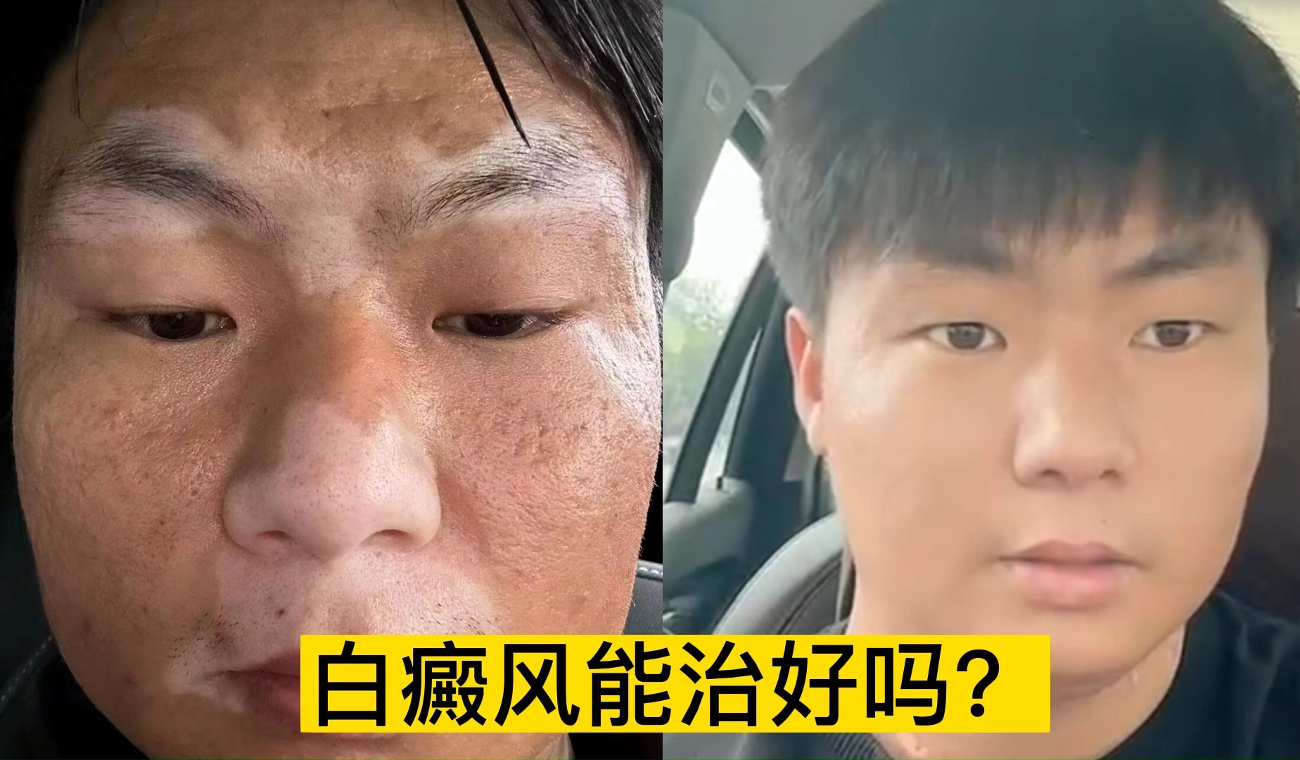 白癜风能治好吗?