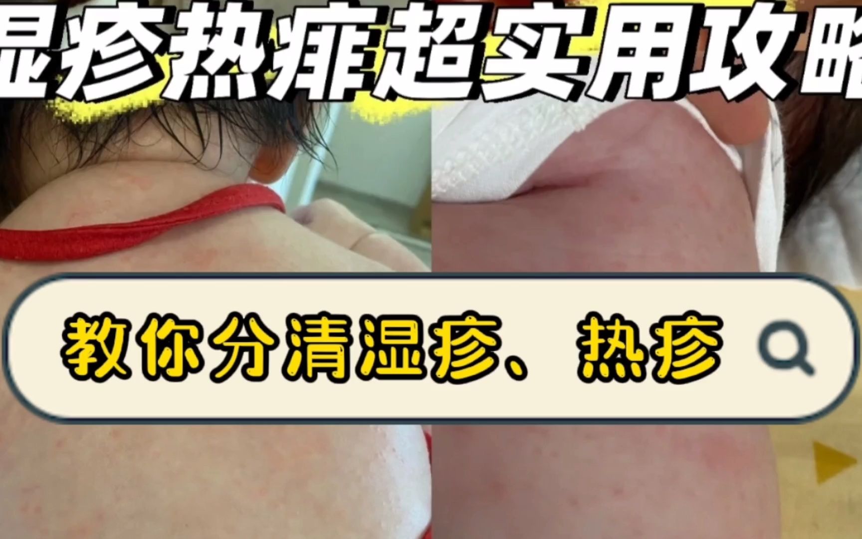 一分钟!教你如何分辨湿疹、热疹!哔哩哔哩bilibili