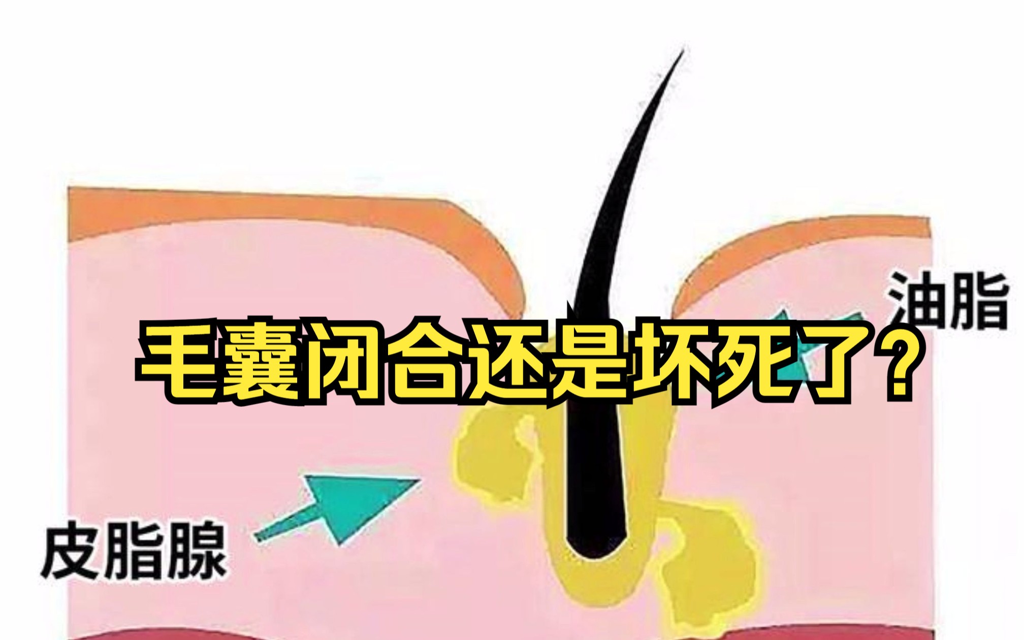 科普头发根部的小白点是毛囊吗?哔哩哔哩bilibili