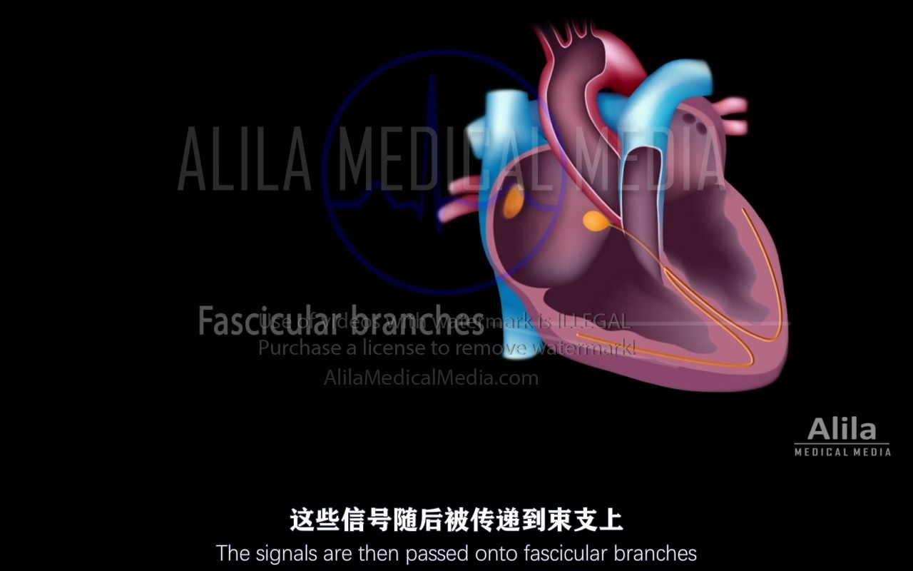 【Alila Medical Media】75.房室传导阻滞心脏传导阻滞(AV阻滞)类型第1部分哔哩哔哩bilibili