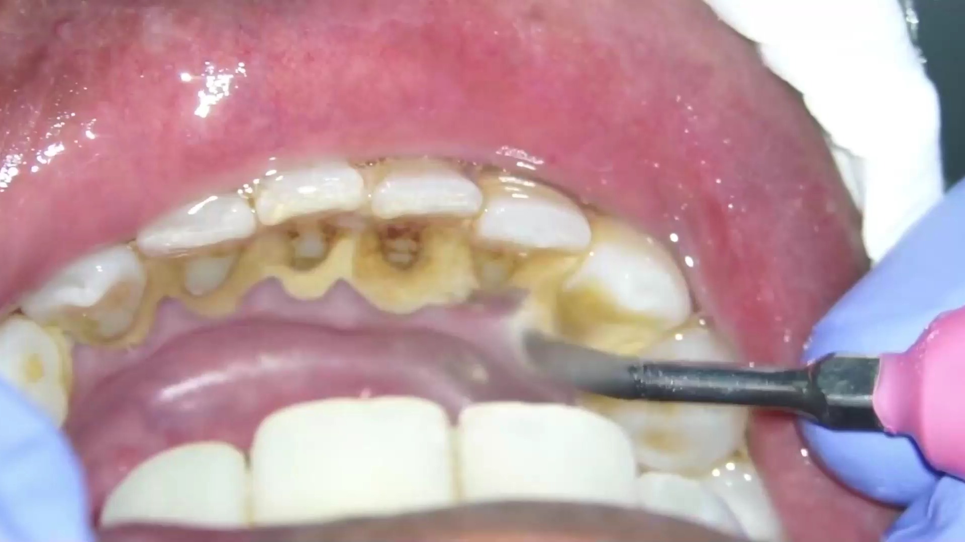 为什么牙齿缝隙发黑还有臭味为什么在线 为什么牙齿缝隙发黑还有臭味为什么在线