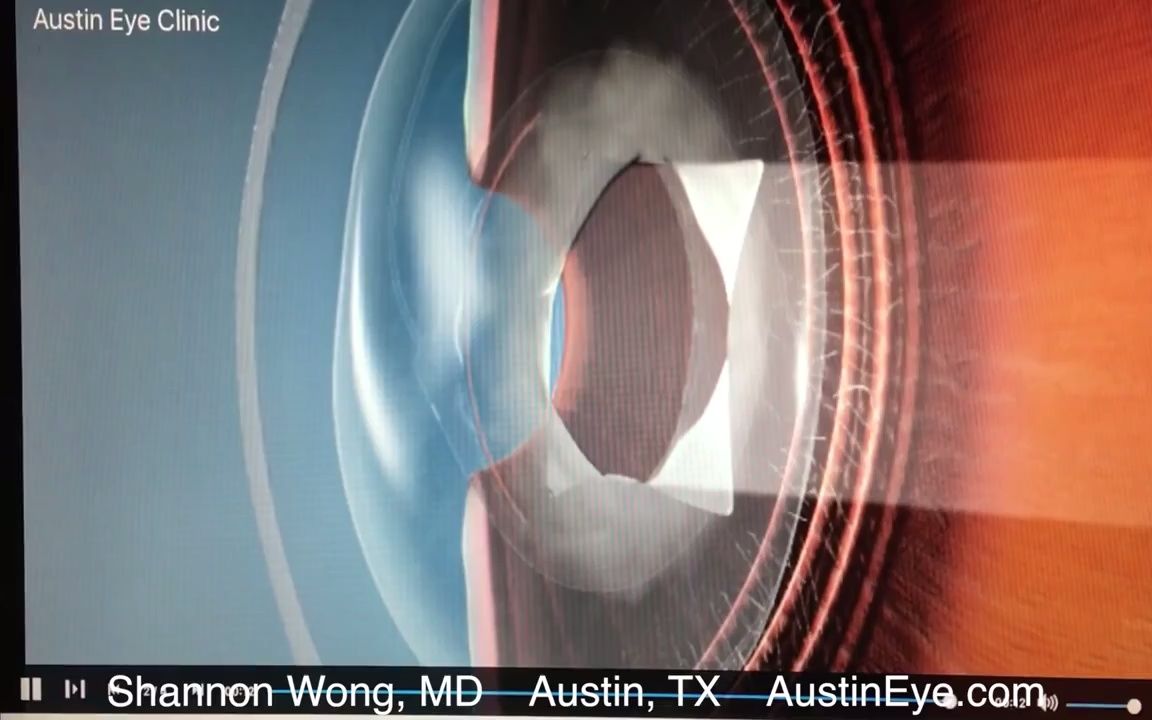 【中英双字】【YAG激光治疗后发障】Yag capsulotomy stepbystep哔哩哔哩bilibili