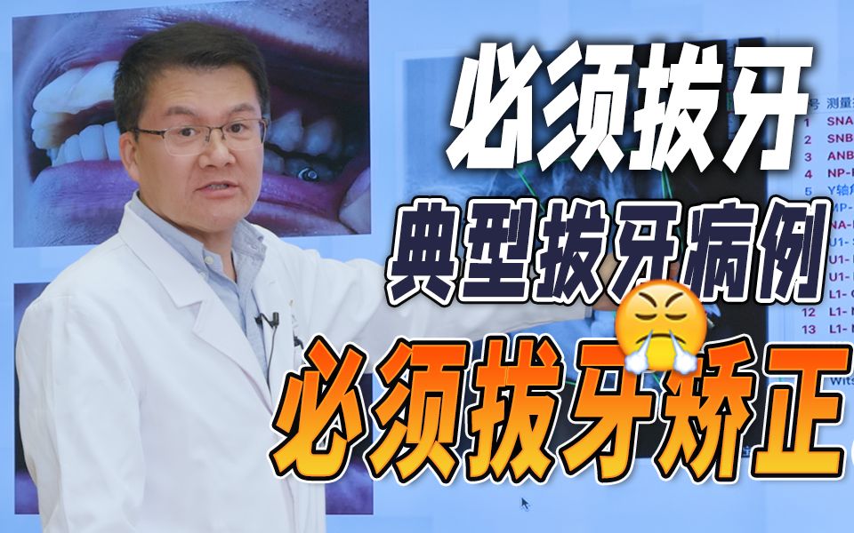 牙齿突应该拔牙矫正却没有拔牙,会怎么样?哔哩哔哩bilibili