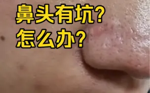 Download Video: 鼻头毛孔坑？痘坑？超难的鼻头坑我终于填平了！！