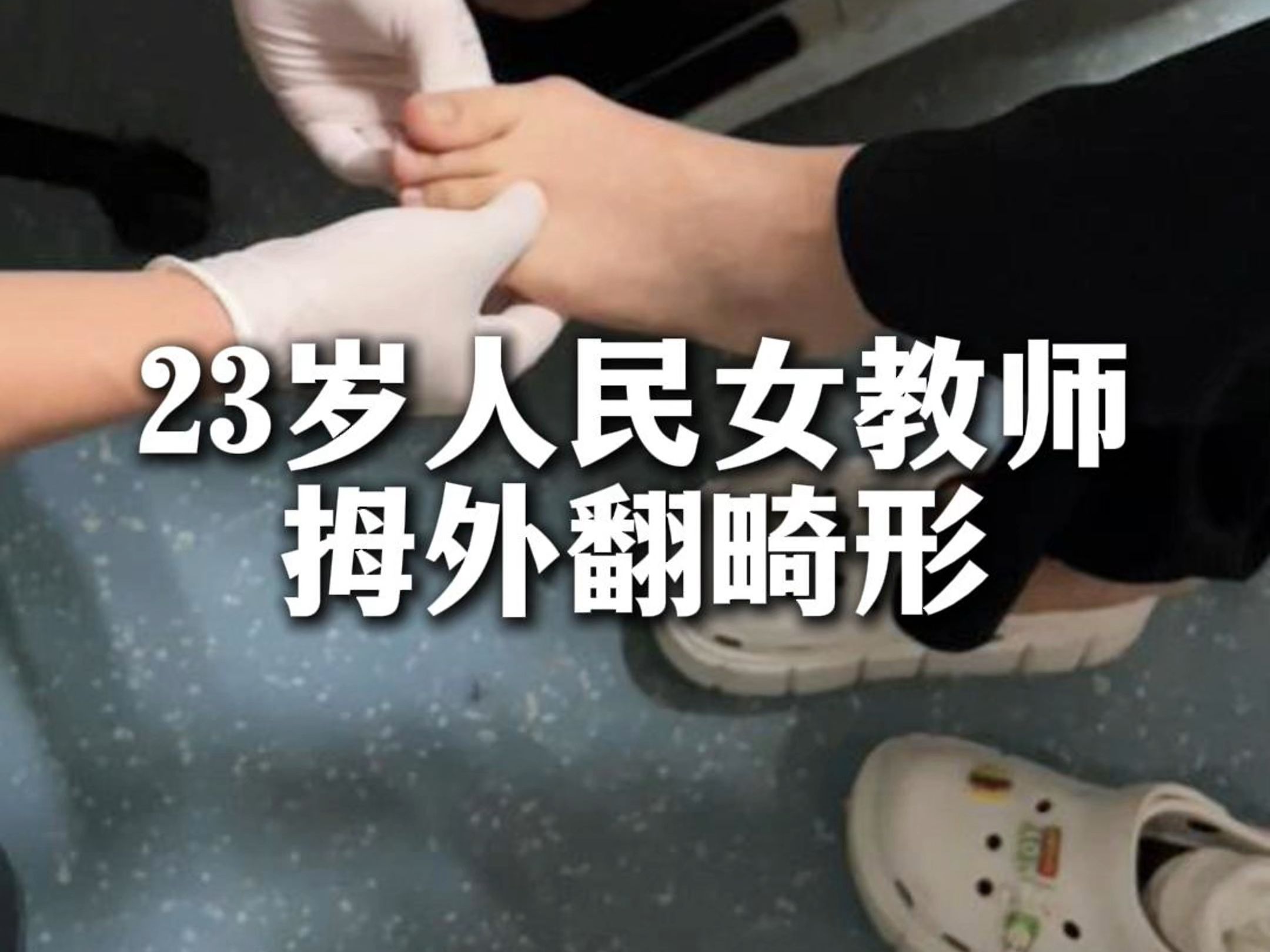 23岁女老师 脚趾拇外翻畸形哔哩哔哩bilibili