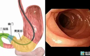 胃镜检查是如何进行的？