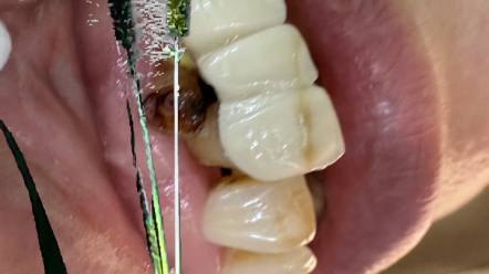 不良修复体拆除,期待7天后的变化